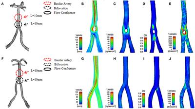 Hemodynamic Differences Between Basilar Artery Fenestration and Normal Vertebrobasilar Artery: A Pilot Study